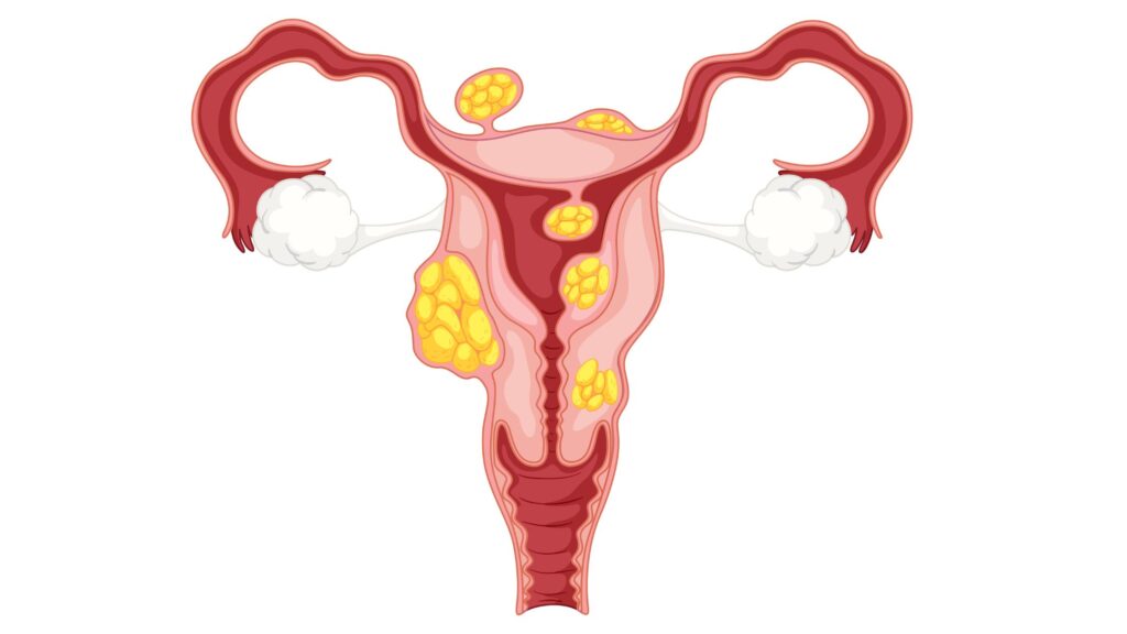 Illustration of uterine fibroids for Fibroid Care Hospital Thrissur showing different fibroid growth locations in the uterus